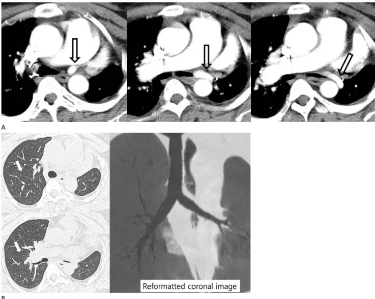 Fig. 3. Hypoplastic left pulmonary artery associated with lobar agenesis of the lung in a 40-year-old woman