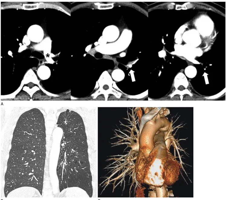 Fig. 5. Hypoplastic left pulmonary artery in Swyer-James syndrome in a 61-year-old man.