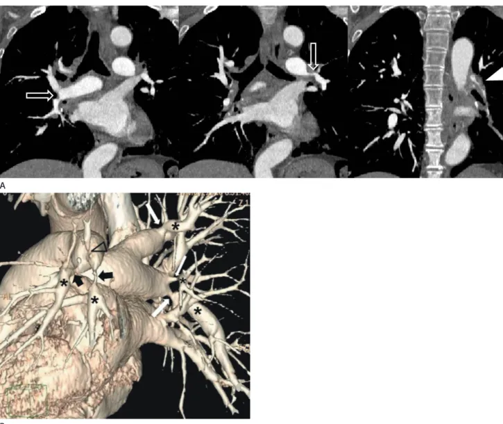 Fig. 6. Multiple stenoses and post-stenotic dilatation of the bilateral pulmonary arteries by chronic pulmonary thromboembolism in a 56-year- 56-year-old man.