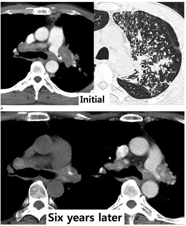Fig. 9. Constriction of the left pulmonary artery by fibrosing mediastinitis in a 46-year-old woman.