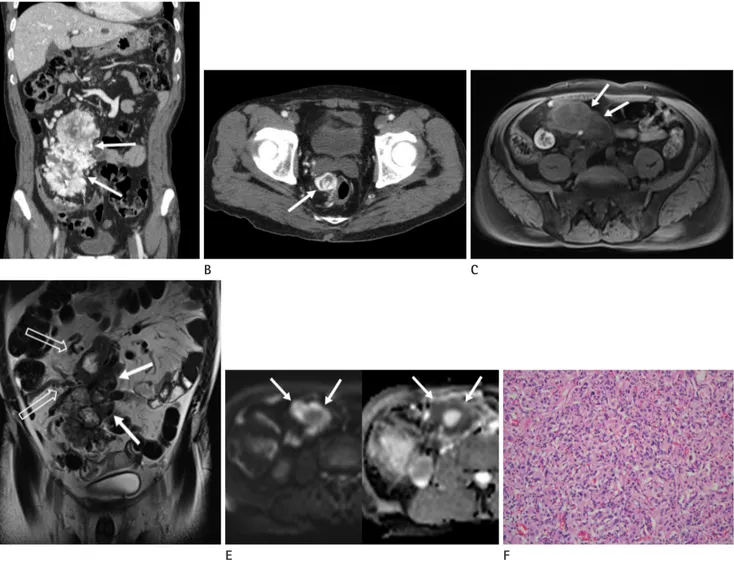 Fig. 1. Mesenteric and pararectal paragangliomas in a 70-year-old man.