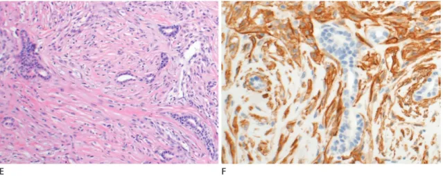 Fig. 1. A 55-year-old woman with myoepithelial carcinoma arising within adenomyoepithelioma.