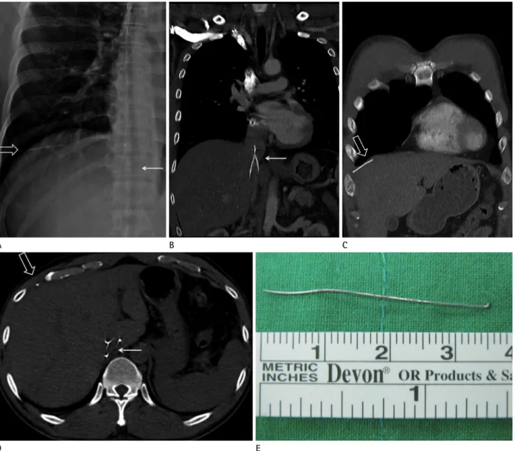 Fig. 1. Fracture of an IVC filter strut and its embolization to the liver, in a 35-year-old man