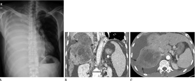 Fig. 1. Hemothorax caused by spontaneous rupture of hepatocellular carcinoma in the pleural cavity in a 51-year-old male.