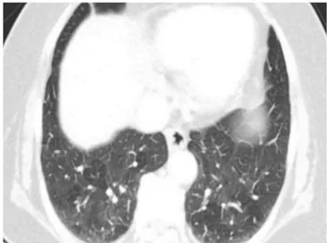 Fig. 3. Mosaic attenuation pattern in lower lungs in CT scan of a  76-year-old woman. It is caused by expiration or limited respiration  dur-ing CT examination.