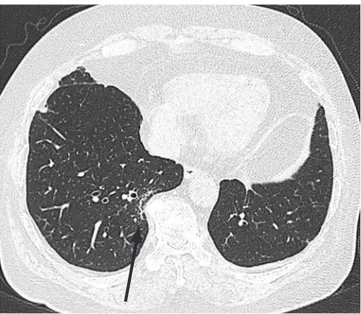 Fig. 4. Subtle reticular densities in both lower subpleural lungs on CT  in an asymptomatic 76-year-old woman non-smoker