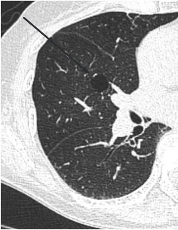 Fig. 9. Chest radiograph (A) and CT (B) show diffuse cartilage calcification along the tracheobronchial wall in 83-year-old-woman.