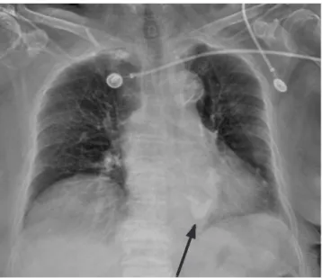 Fig. 12. Chest radiograph shows mild cardiomegaly, mitral annular  calcification (arrow), and diffuse aortic wall calcification in a  92-year-old woman.
