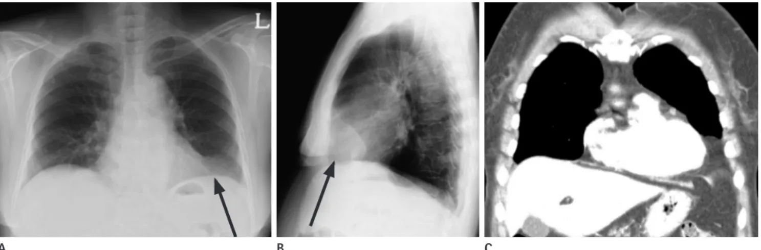 Fig. 14. Chest radiographs (A, B) in a 72-year-old woman show mass opacity (arrows) in the left cardiophrenic angle area, which is classic ap- ap-pearance of prominent paracardaic fat pad
