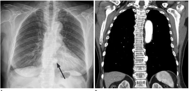 Fig. 16. Chest radiograph (A) in a 75-year-old woman shows a nodular opacity in the left paraspinal area (arrow), which corresponds to the  bridging osteophytes on CT (B).