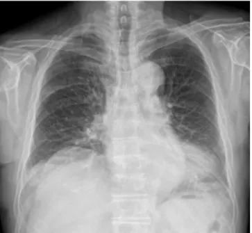 Fig. 19. Chest radiograph (A) in an 80-year-old woman shows a large mass opacity with internal air density in the left retrocardiac area (arrows)