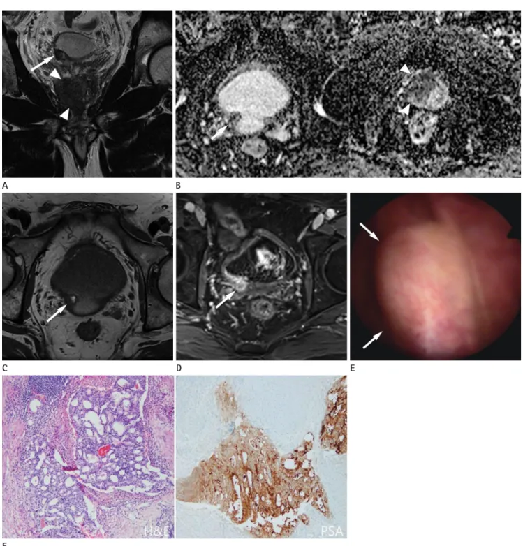 Fig. 1. A Solitary bladder metastasis of prostate cancer in a 75-year-old man.