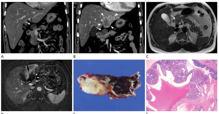 Fig. 1. Intrahepatic cholangiocarcinoma in a 37-year-old man, initially presented as a distant metastatic lymph node without demonstrable he- he-patic mass