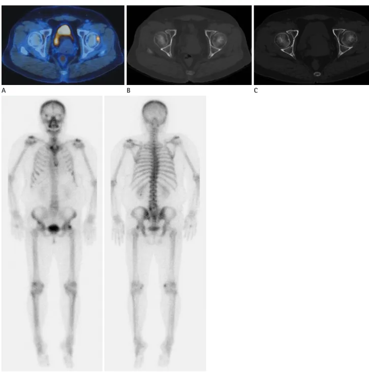 Fig. 1. Transient  18 F-FDG activity of herniation pit, in a 53-year-old woman with thyroid cancer.