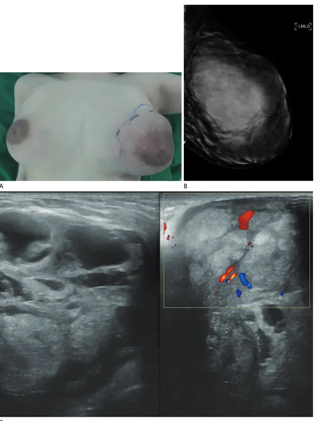 Fig. 1. A 30-year-old postpartum woman with spontaneous infarction of phylloides tumor, presenting as a huge palpable non-tender mass in  her left breast.