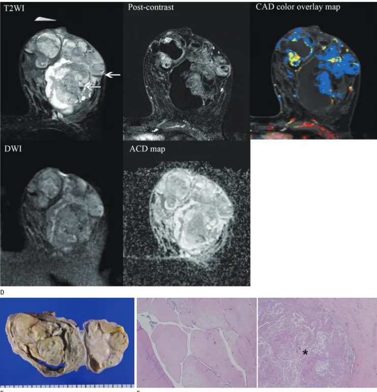 Fig. 1. A 30-year-old postpartum woman with spontaneous infarction of phylloides tumor, presenting as a huge palpable non-tender mass in  her left breast.