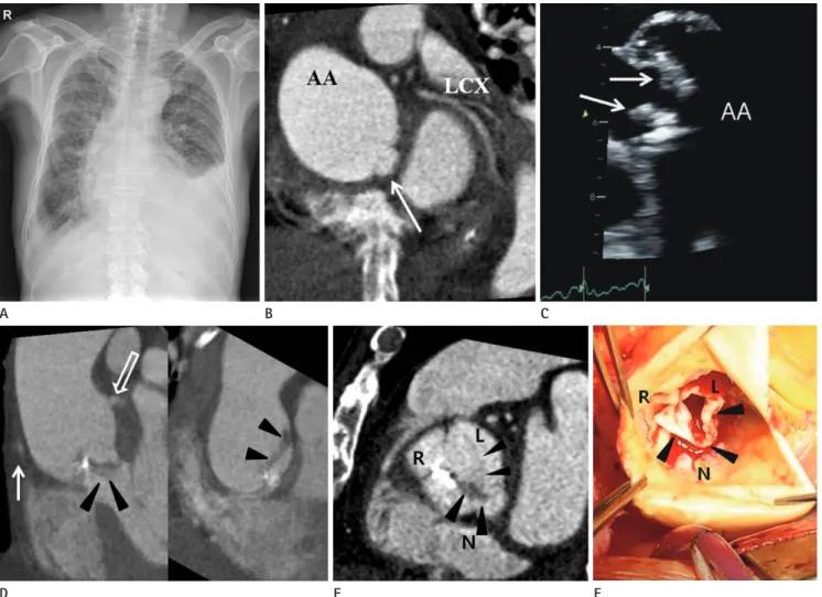 Fig. 1. Localized aortic dissection at the sinus of Valsalva with vegetations and dystrophic calcification in a 69-year-old man
