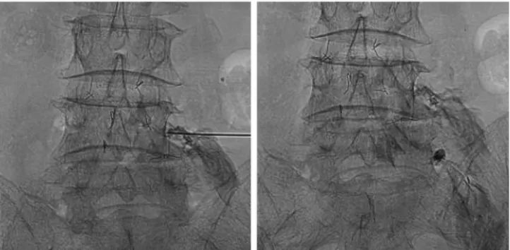 Fig. 2. Radiographs of 65-year-old man with severe back pain and ra- ra-diating pain to right buttock
