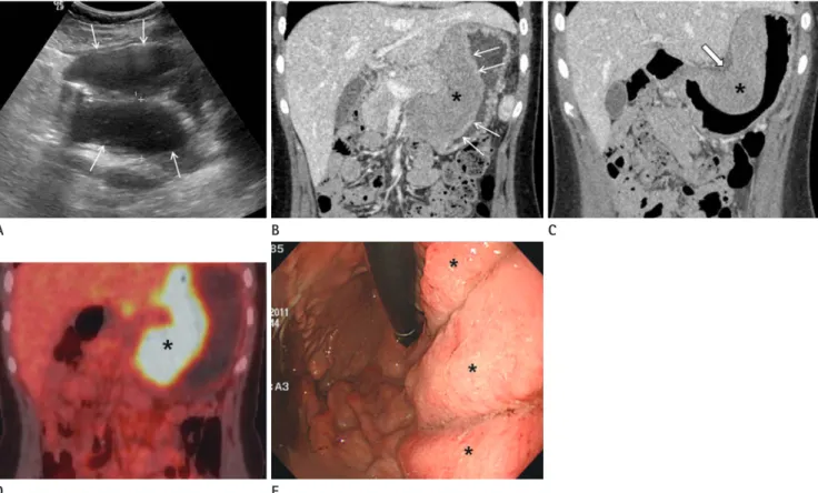 Fig. 1. Multimodal imaging of isolated myeloid sarcoma in a nonleukemic child.