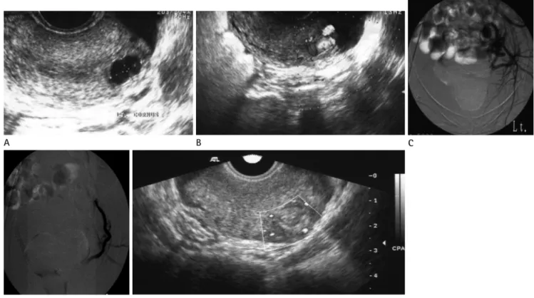 Fig. 1. A 27-year-old woman presented with vaginal bleeding for 2 months after D &amp; E.