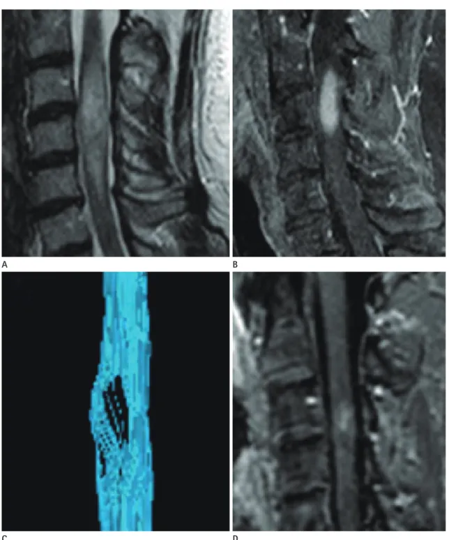 Fig. 2. A 52-year-old woman with sudden-onset progressive left side weakness and binocular diplopia, who was clinically confirmed as having  an inflammatory intramedullary spinal cord lesion (case number 5)