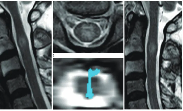 Fig. 3. A 54-year-old woman with pain in both shoulders, who was clinically confirmed as having a neoplastic intramedullary spinal cord lesion  (case number 6)