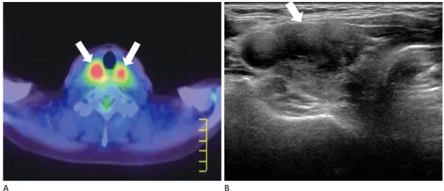 Fig. 2. Hashimoto’s thyroiditis, a 54-year-old woman, screening.