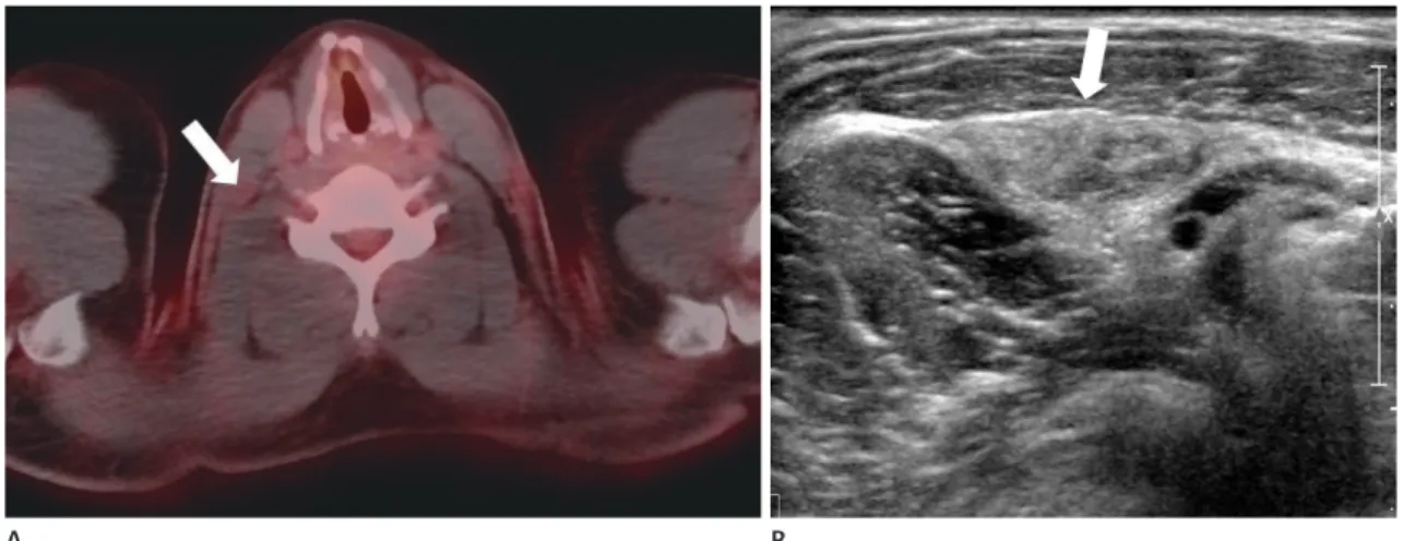 Fig. 6. Traumatic neuroma, a 32-year-old man with total thyroidectomy for papillary thyroid cancer.