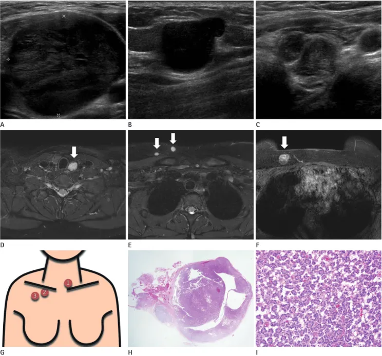Fig. 1. Simultaneous seeding of follicular thyroid adenoma around both the operative bed and along the subcutaneous tunnel of the upper chest  wall after endoscopic thyroidectomy in a 14-year-old female