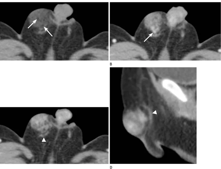 Fig. 2. A 5-month-old boy with fibrous hamartoma of infancy; contrast enhanced CT evaluation of the abdomen