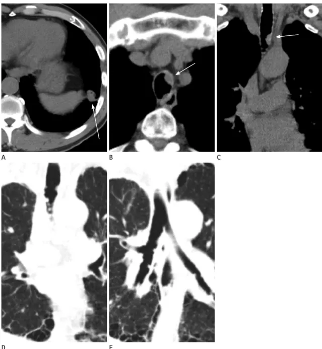 Fig. 1. A case of squamous cell carcinomas of the lung, which presented as multiple tracheobronchial polyps in a 61-year-old male