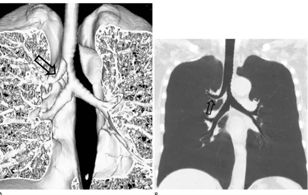 Fig. 4. True tracheal bronchus (Type III) in a 49-year-old man with chronic cough and dyspnea.