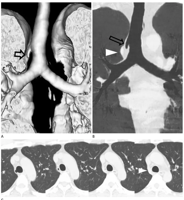 Fig. 5. True tracheal bronchus (Type IV) in an asymptomatic 53-year-old man.