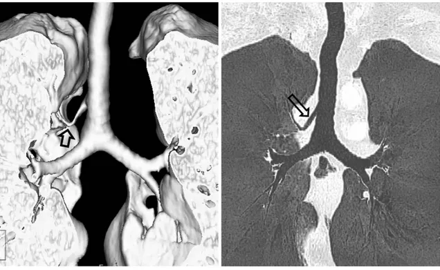 Fig. 6. True tracheal bronchus (Type V) in a 71-year-old man with chronic cough.