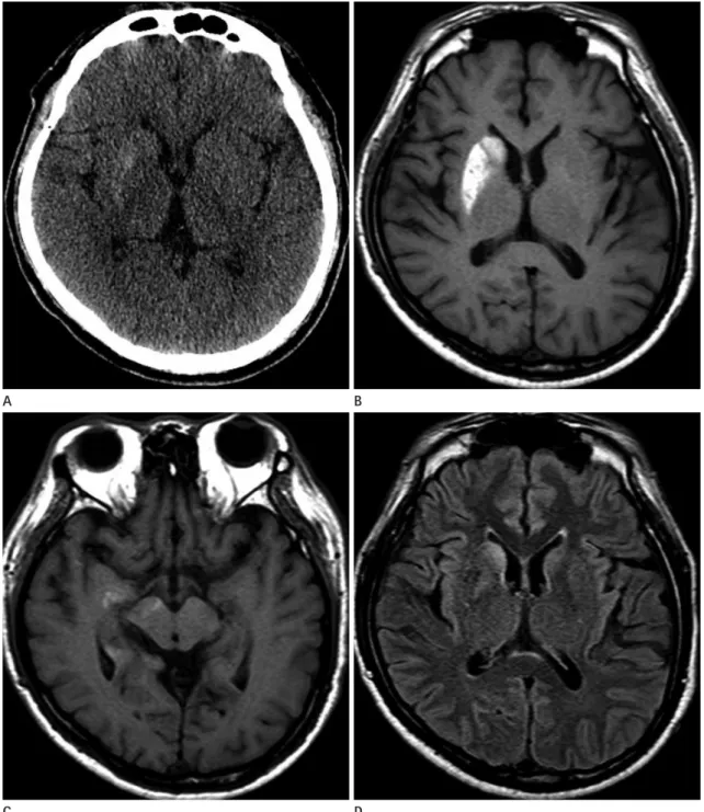 Fig. 1. MRI of a 51-year-old man with involuntary movement of the left arm and leg. A non-contrast CT scan (A) shows a hyperattenuating le- le-sion in the right caudate nucleus and putamen