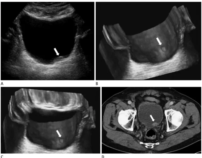 Fig. 1. Superficial polypoid bladder tumor.