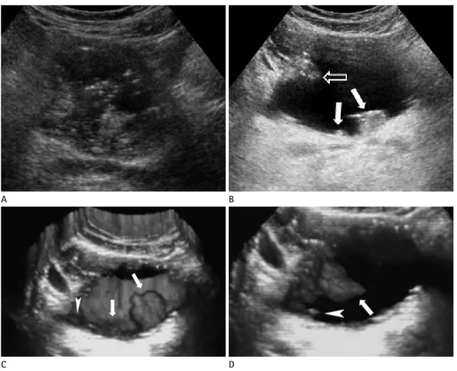 Fig. 2. Multiple superficial polypoid bladder tumors.