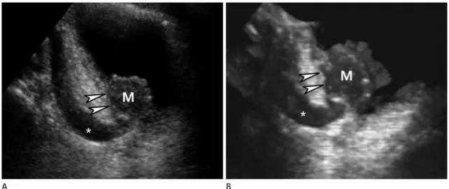 Fig. 4. Infiltrative bladder cancer in UVJ with hydroureter.