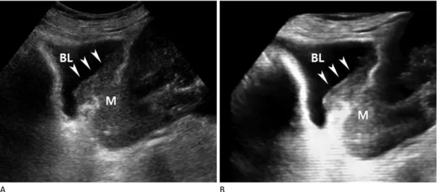 Fig. 5. Direct invasion of the urinary bladder by advanced cervical cancer.