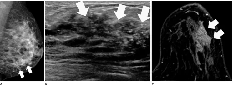 Fig. 3. Human epidermal growth factor receptor-2 enriched type breast cancer of 38-year-old woman.