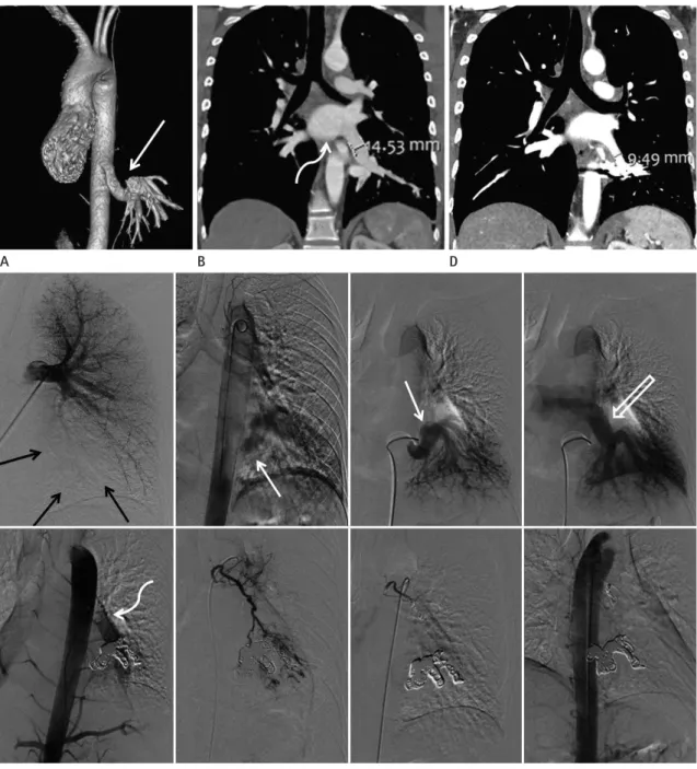 Fig. 1. Aberrant systemic arterial supply to the normal lung treated with transarterial embolization in a 24-year-old man.