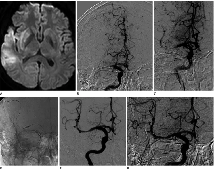 Fig. 2. Angioplasty was performed as a rescue method after failure of a Solitaire stent for mechanical thrombectomy
