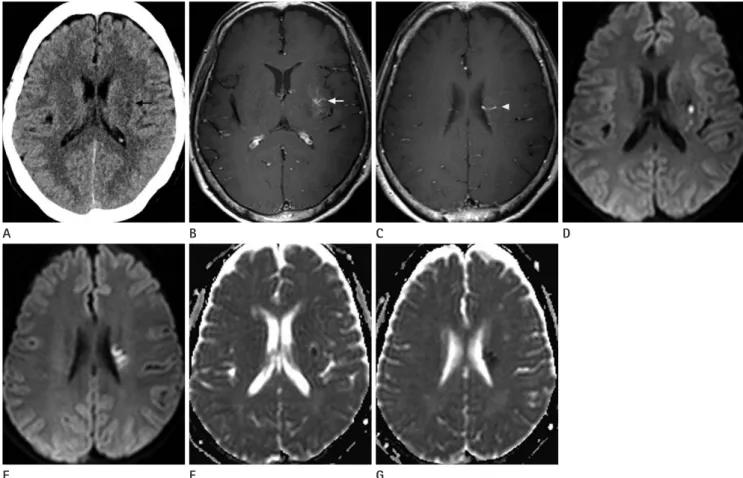 Fig. 1. Venous infarction of developmental venous anomaly in a 63-year-old woman who presented with an acute onset of right side motor  weakness and sensory changes.