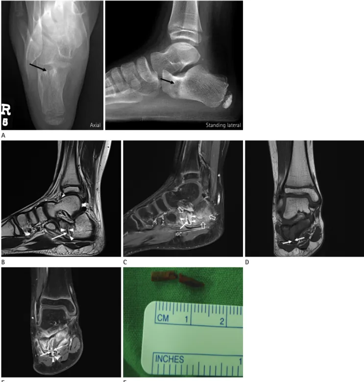 Fig. 1. A 9-year-old boy with an unrecognized foreign body retained in the calcaneus.