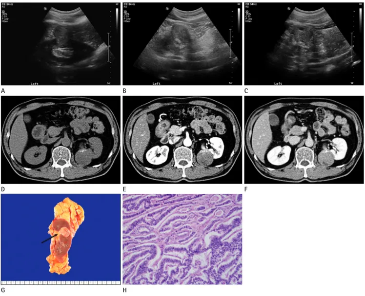 Fig. 1. A 55-year-old male with primary renal carcinoid tumor.