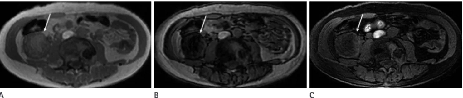 Fig. 5. 82-year-old man with clear cell renal cell carcinoma in left kidney.