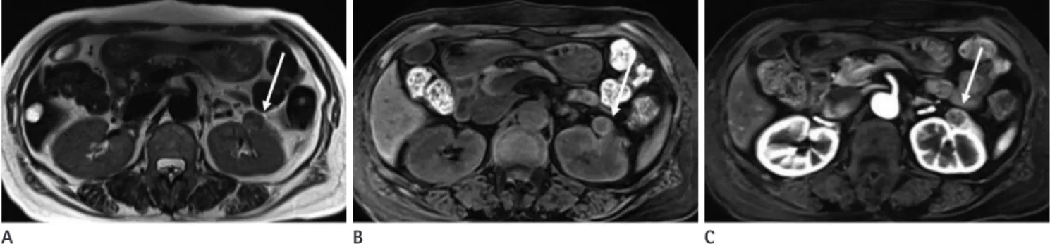Fig. 6. 71-year-old woman with chromophobe renal cell carcinoma in left kidney.