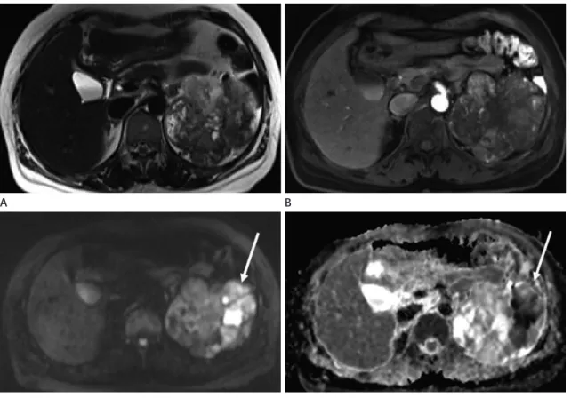 Fig. 7. 47-year-old woman with clear cell renal cell carcinoma in left kidney.