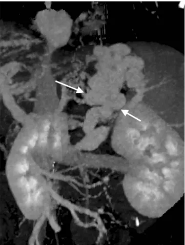 Fig. 2. Preprocedural evaluation of PARTO in a 49-year-old man. The  3D volume rendering image provides clear visualization of the  gastro-renal shunt (white arrows) and collateral vessels, as well as the  pres-ence and size of the gastrorenal shunt and ve