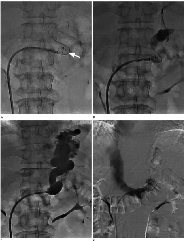 Fig. 3. PARTO procedure (the same patient as in Fig. 2).